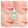 Anti Acne treatment Pimple Remover Serum